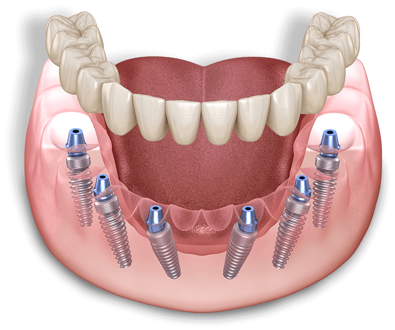 Model of Full Arch Implant