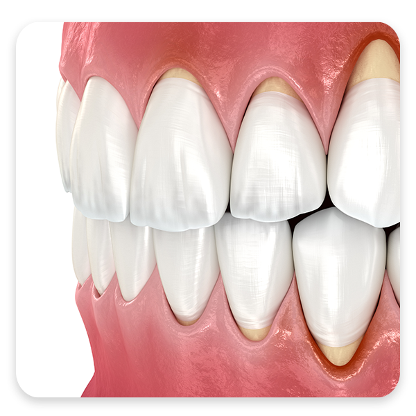 Receded gums