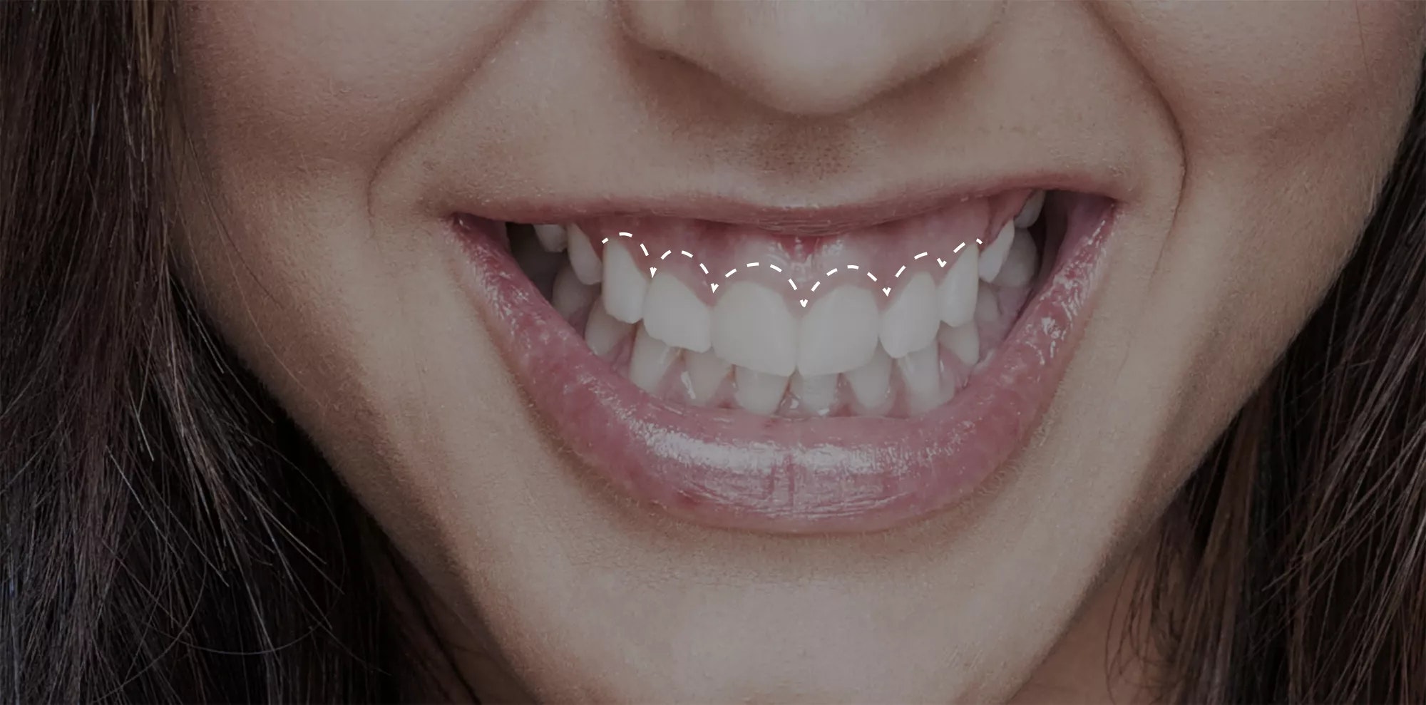 Preview of crown lengthening results