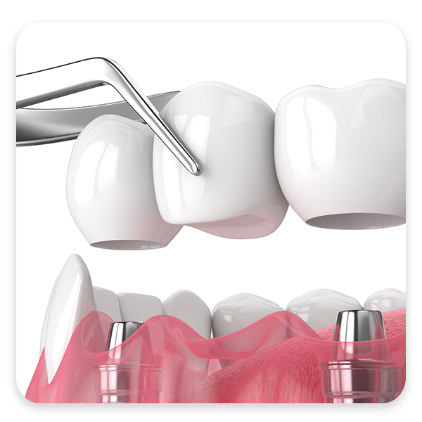 Implant Bridge