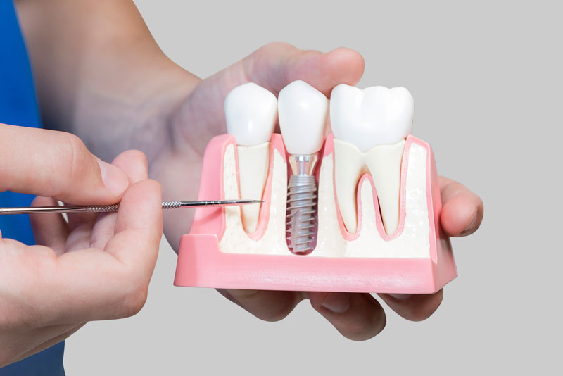 Dental Assistant Showing Off A Dental Implant In A Jawbone Cutaway Model in Albuquerque, NM
