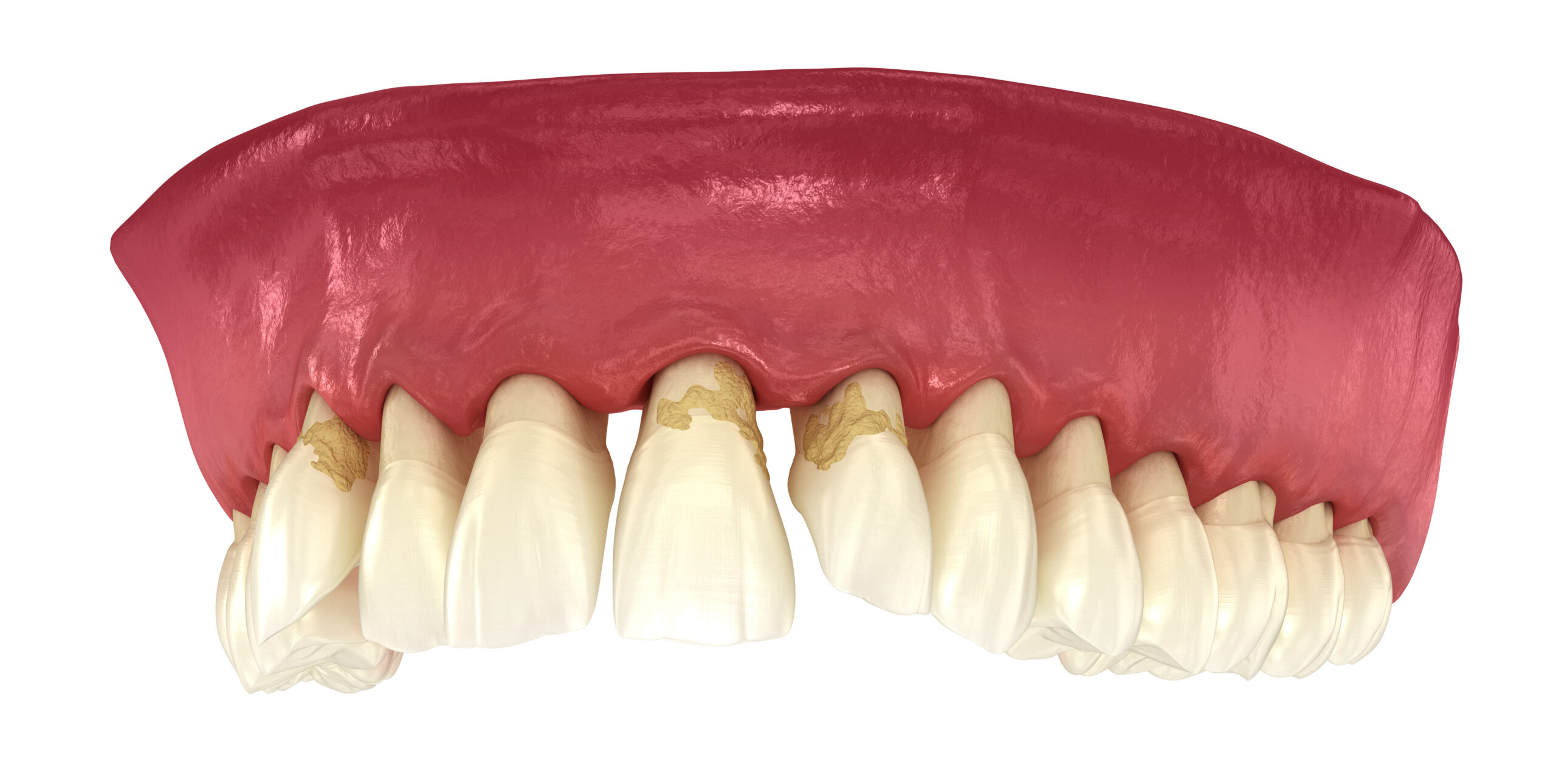 Periodontitis and gum recession. Medically accurate 3D illustration.