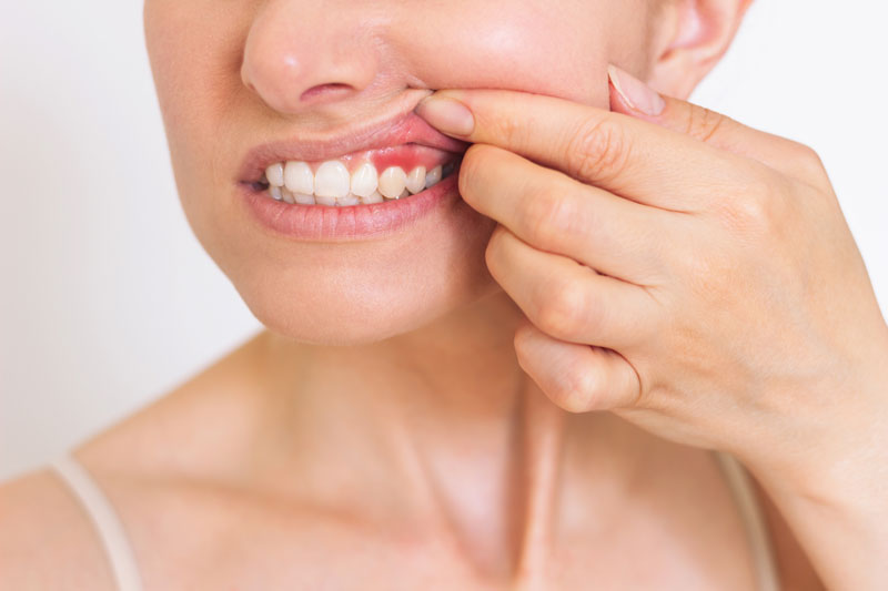 Image of a women lifting up her gums to show inflamation