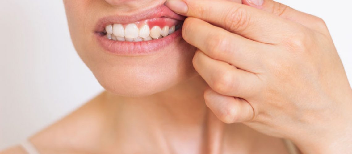 Image of a women lifting up her gums to show inflamation