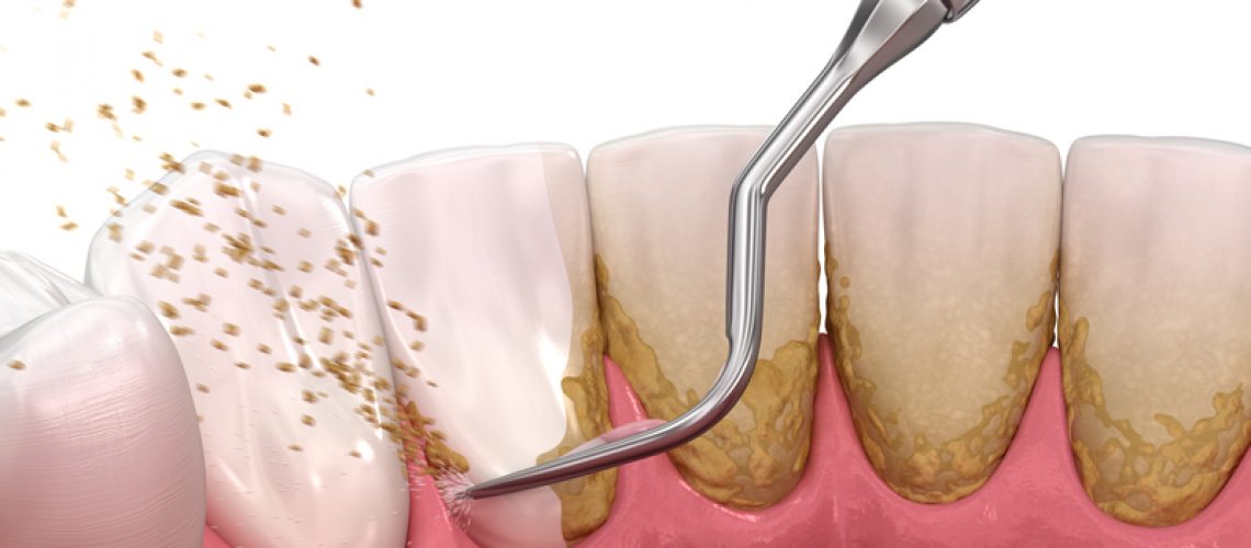 Close-up 3d image of a dental pick taking plaque off teeth