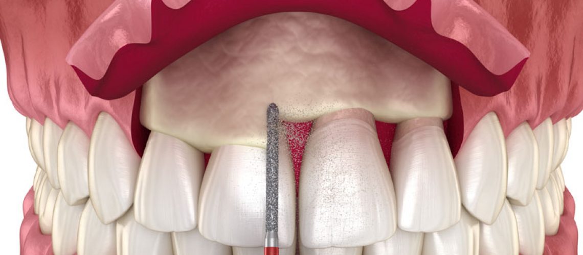 a crown lengthening procedure on a full mouth dental model.