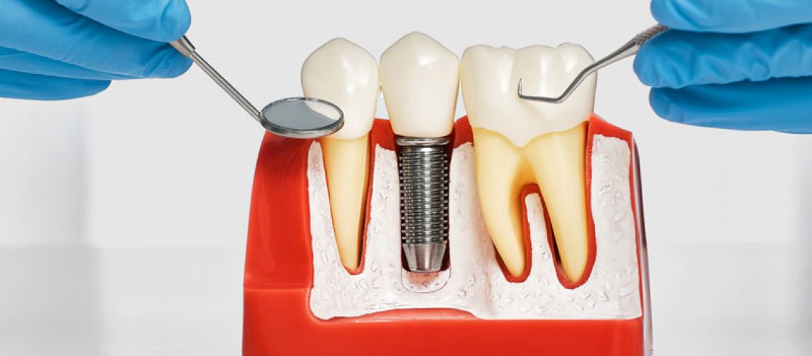 A dental implant model bone cutaway showing Osseointegration