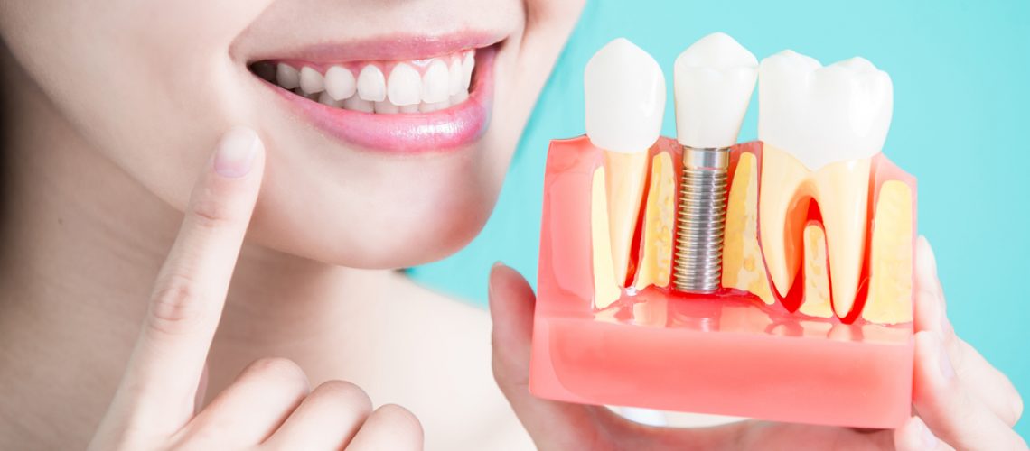The Truth About Dental Implants